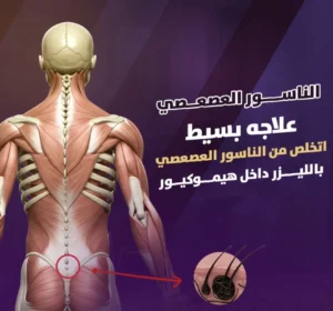 الناسور العصعصي
