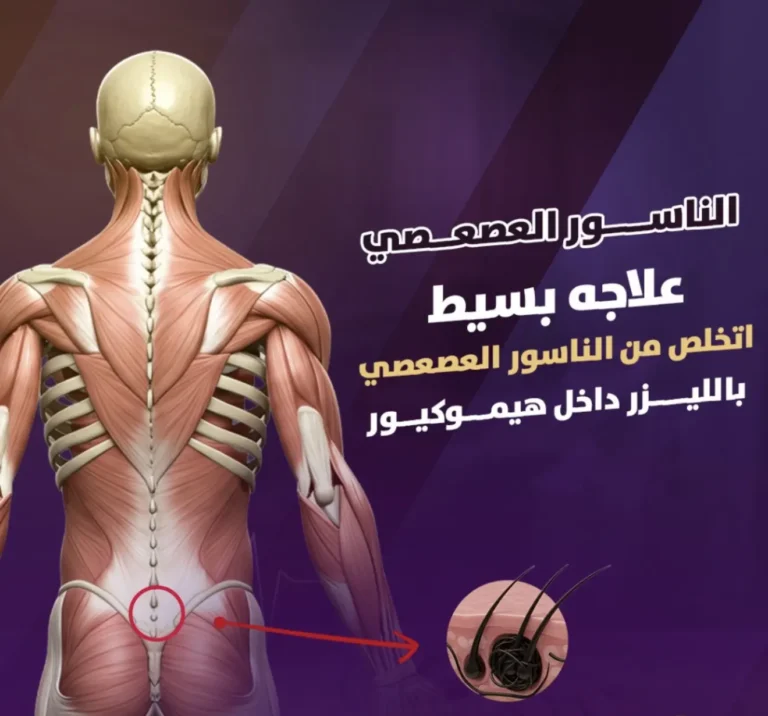 الناسور العصعصي