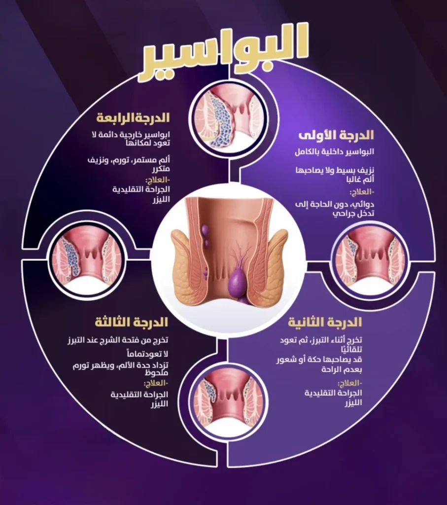 درجات البواسير