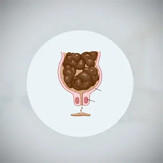 سلس البراز