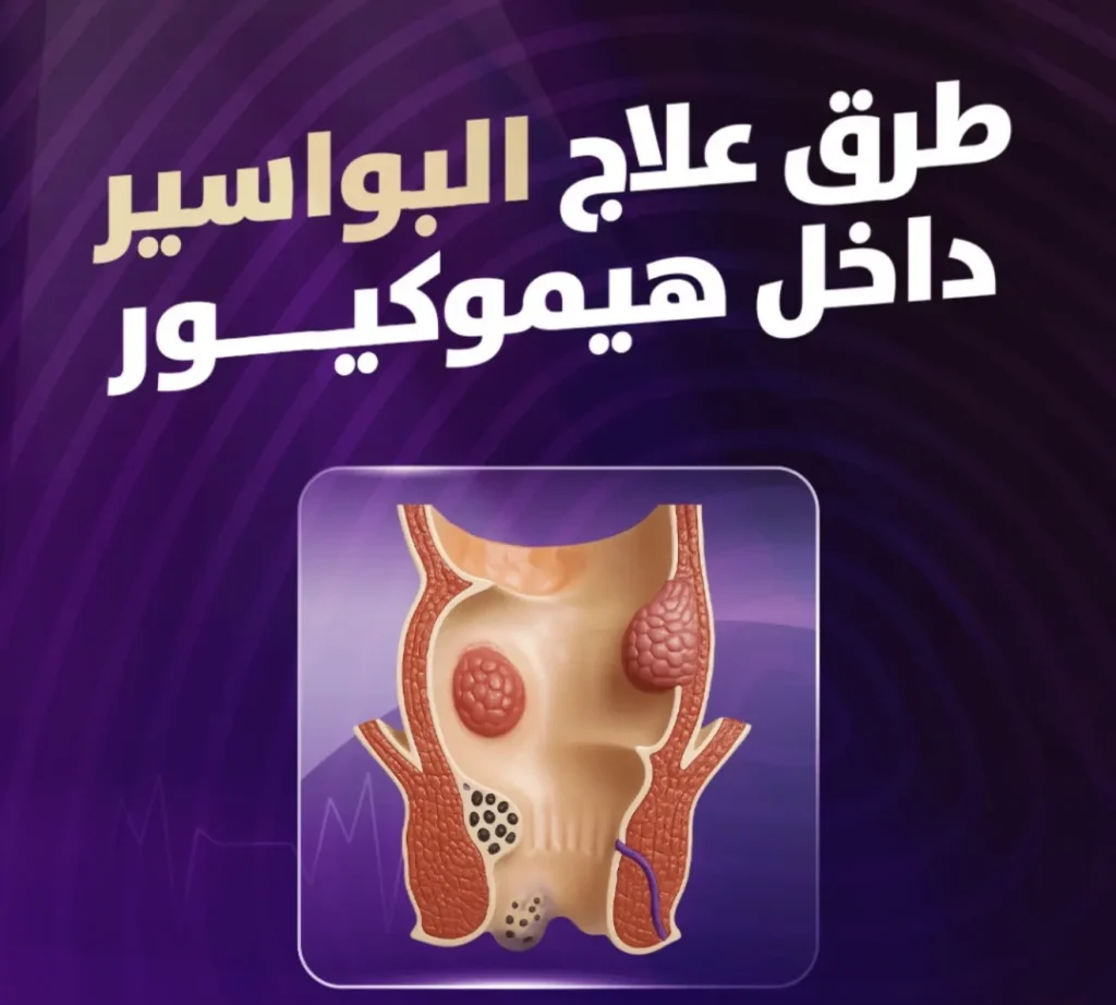 طرق علاج البواسير داخل هيموكيور