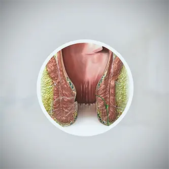 ناسور شرجي